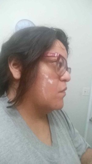 Atopalm Intensive Moisturizing Cream applied to face side view