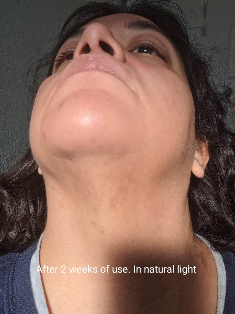 a close-up of my neck in natural light after 2 weeks of using REVITALIFT DERM INTENSIVES 12% [Niacinamide + Amino Sulfonic + Ferulic Acid] Dark Spot Serum