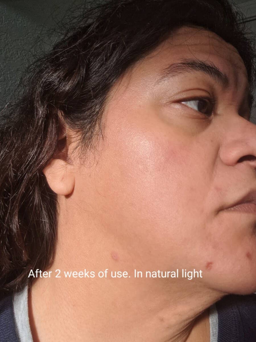 The right side of my face in natural light after 2 weeks of using REVITALIFT DERM INTENSIVES 12% [Niacinamide + Amino Sulfonic + Ferulic Acid] Dark Spot Serum